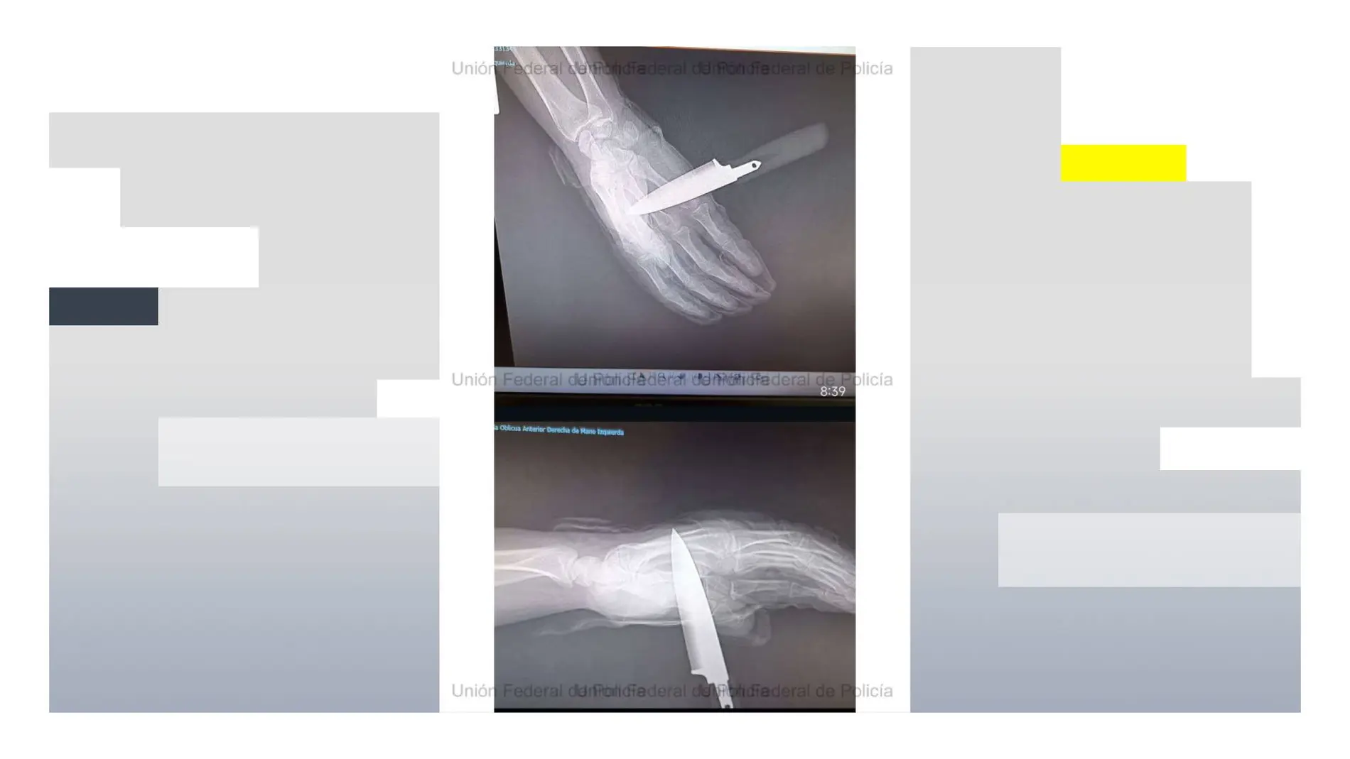 Radiografía de la mano del agente de la Policía Nacional apuñalado en Baza (Granada) Radiografía de la mano del agente de la Policía Nacional apuñalado en Baza (Granada)