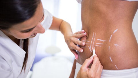 Cirujana plástica marca las zonas a operar en una paciente