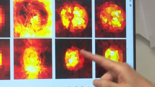 Prueba para detectar glaucoma