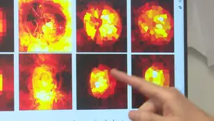 Prueba para detectar glaucoma