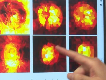 Prueba para detectar glaucoma