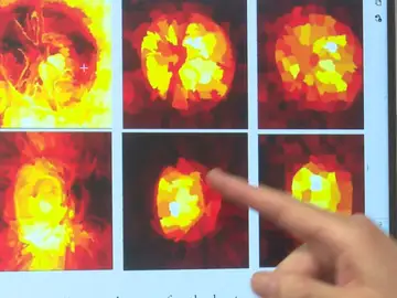 Prueba para detectar glaucoma Prueba para detectar glaucoma