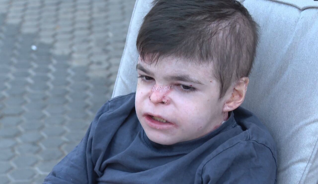 Leo, el menor que sufre piel de mariposa