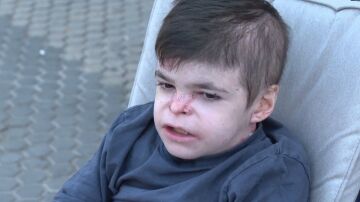 Leo, el menor que sufre piel de mariposa