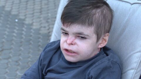 Leo, el menor que sufre piel de mariposa