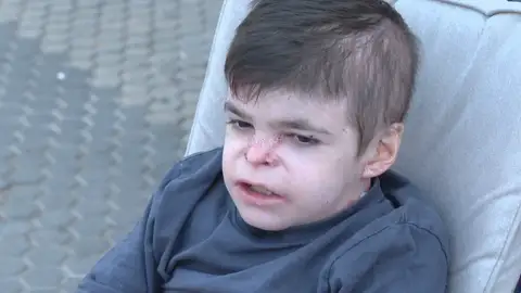 Leo, el menor que sufre piel de mariposa Leo, el menor que sufre piel de mariposa