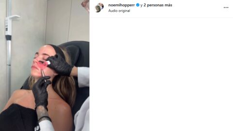 Noemi Hopper sometiéndose a infiltraciones de polinucleótidos