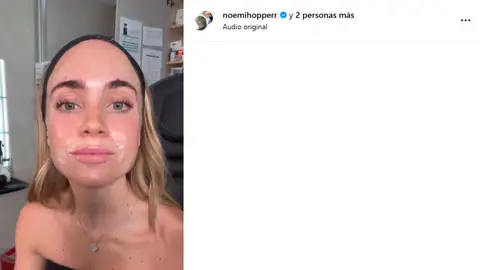 Noemi Hopper tras ponerse bótox en los labios Noemi Hopper tras ponerse bótox en los labios