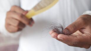 Ca&iacute;da del pelo