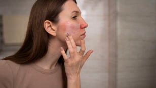 Mujer aplic&aacute;ndose crema en la piel da&ntilde;ada