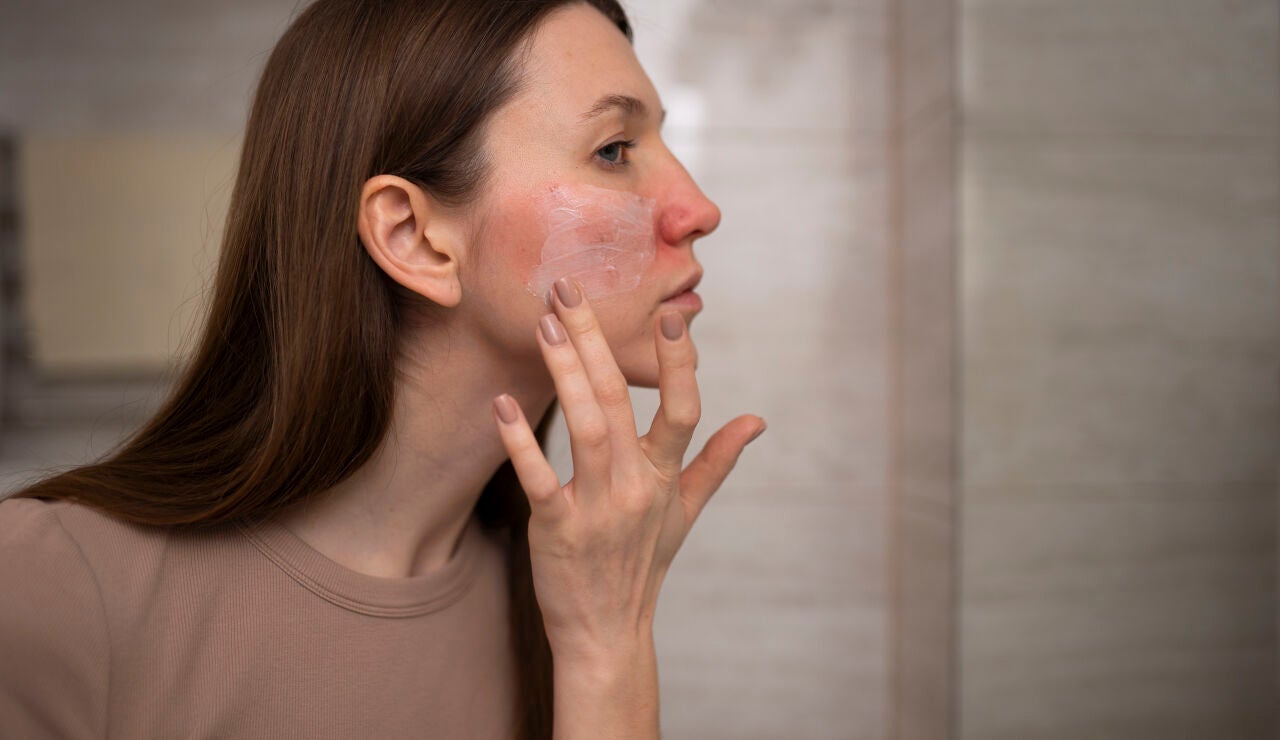 Mujer aplic&aacute;ndose crema en la piel da&ntilde;ada