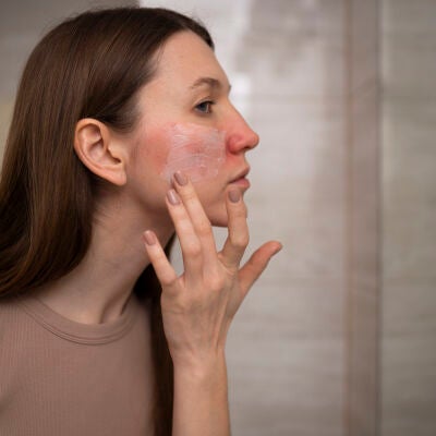 Mujer aplic&aacute;ndose crema en la piel da&ntilde;ada