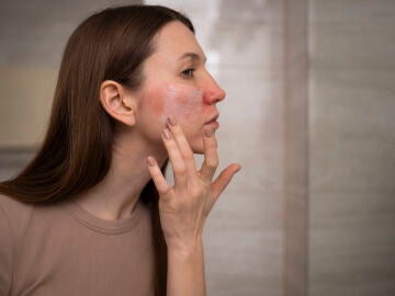 Mujer aplic&aacute;ndose crema en la piel da&ntilde;ada
