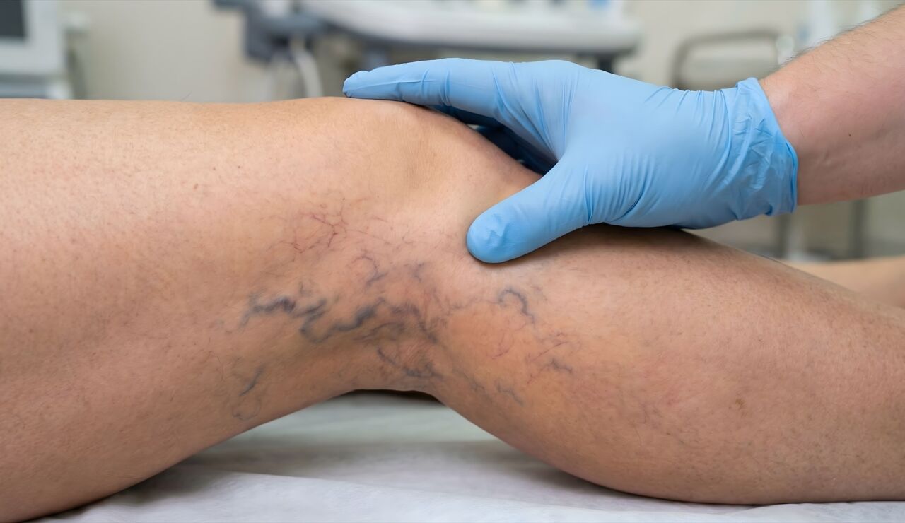 Piernas con varices