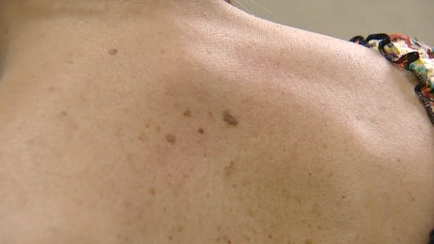 Melanoma Melanoma