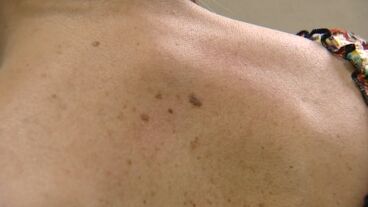 Melanoma