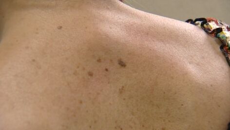 Melanoma
