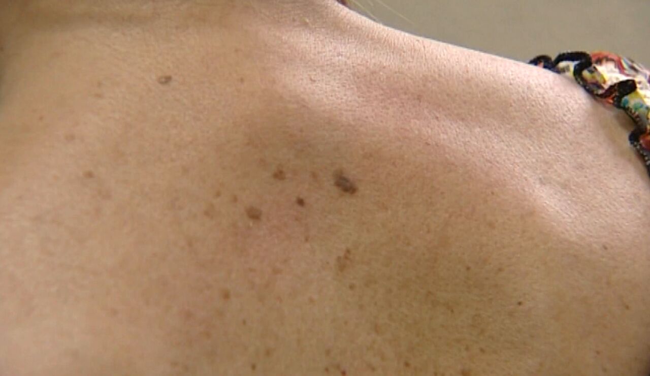 Melanoma
