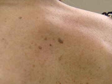 Melanoma