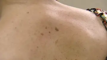Melanoma Melanoma