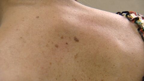 Melanoma
