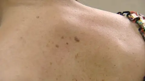Melanoma Melanoma