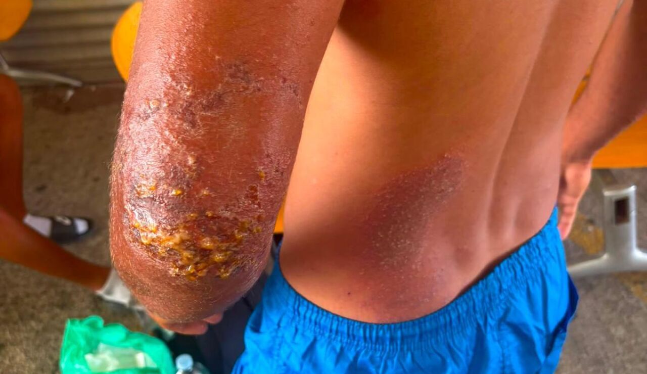 Migrante infectado de sarna en Ceuta