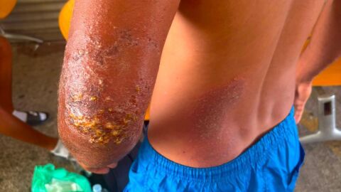 Migrante infectado de sarna en Ceuta