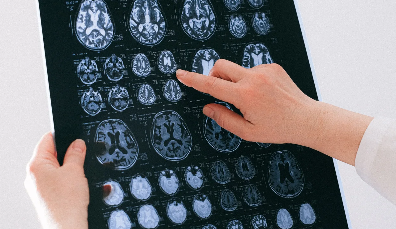 Un profesional médico examina una resonancia magnética del cerebro, centrándose en la salud neurológica