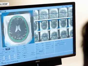 Un implante cerebral Un implante cerebral
