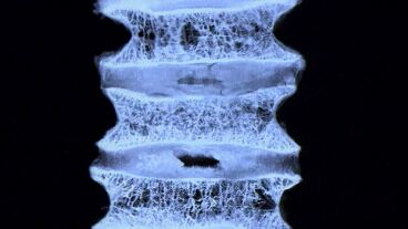 Estudio osteoporosis