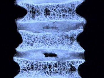 Estudio osteoporosis