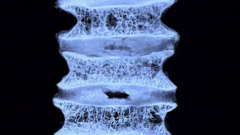 Estudio osteoporosis