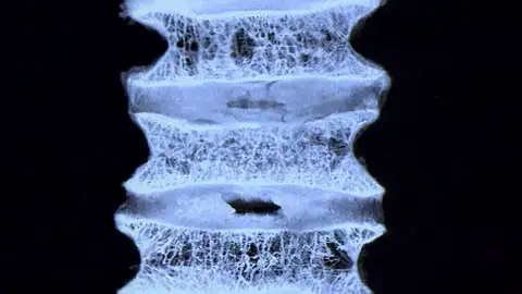 Estudio osteoporosis Estudio osteoporosis