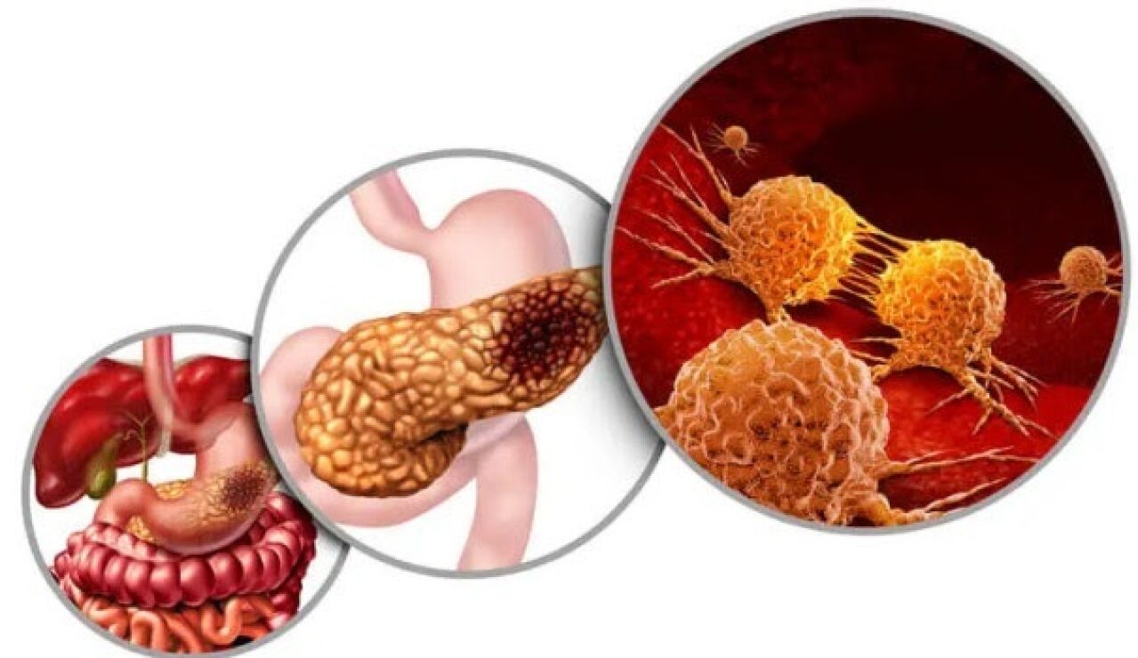 Infograf&iacute;a para el c&aacute;ncer de p&aacute;ncreas