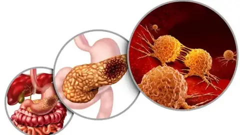 Infografía para el cáncer de páncreas Infografía para el cáncer de páncreas
