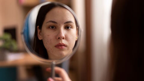 Mujer con marcas de acné