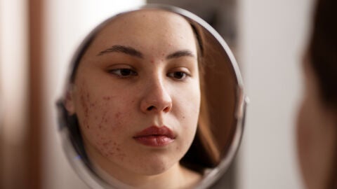 Mujer con acné