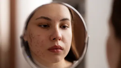 Mujer con acné Mujer con acné