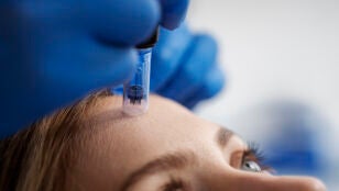 Microneedling
