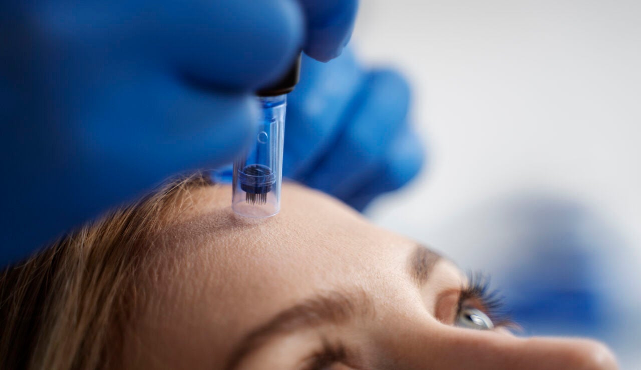 Microneedling