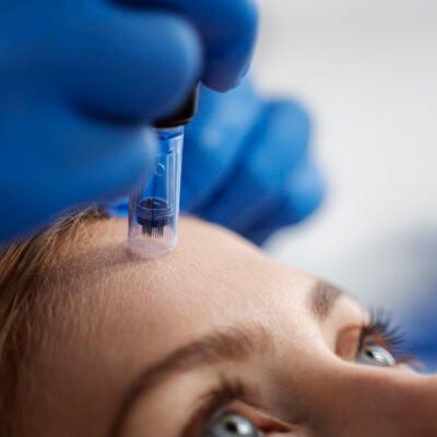 Microneedling