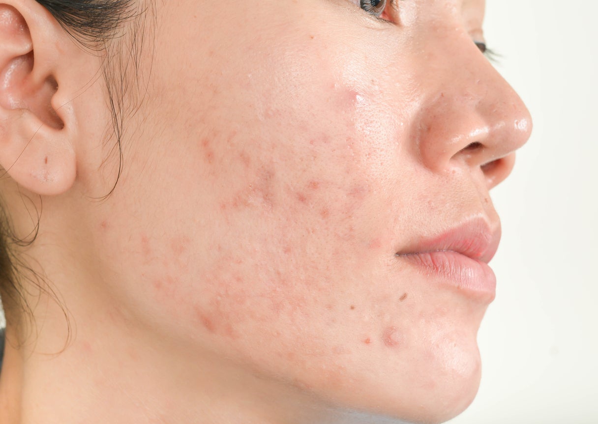 mascarilla para acne casera