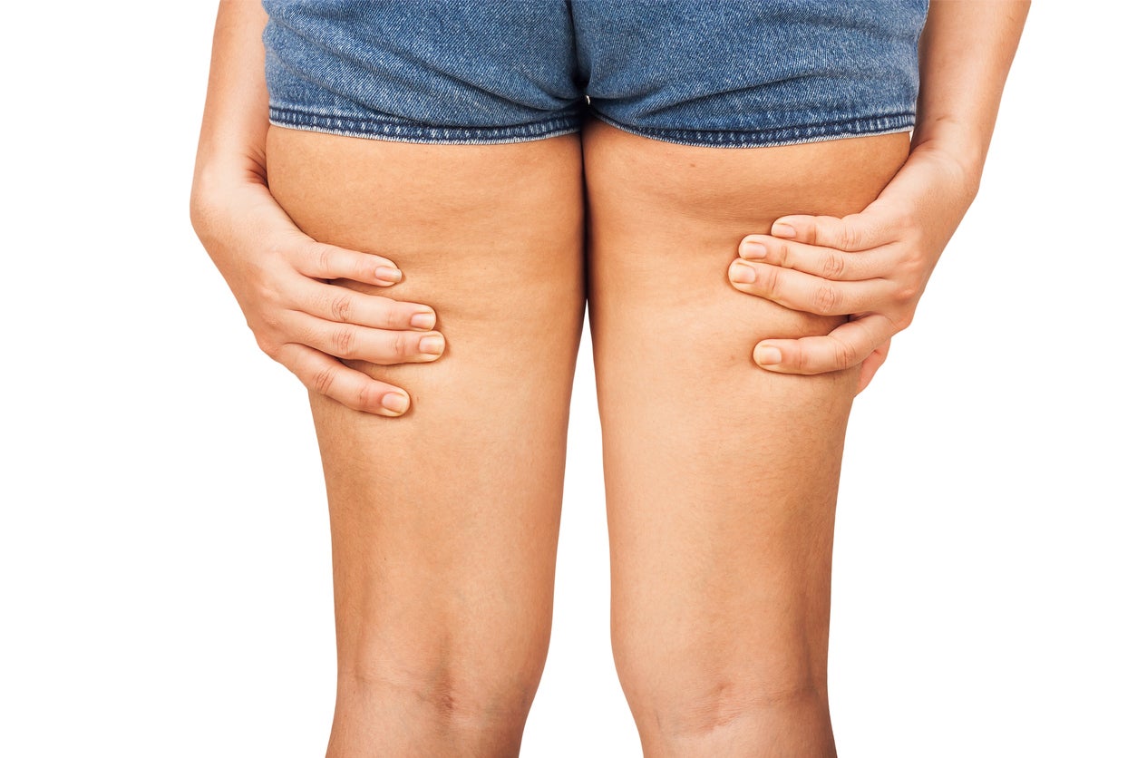 celulitis y shorts