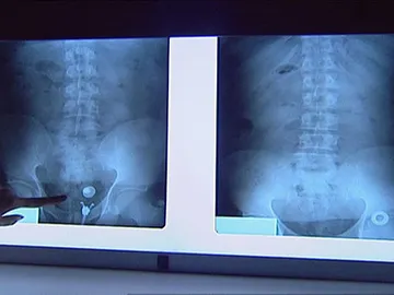 Mujeres embarazadas para el tráfico de drogas Mujeres embarazadas para el tráfico de drogas