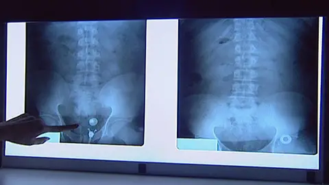 Mujeres embarazadas para el tráfico de drogas Mujeres embarazadas para el tráfico de drogas