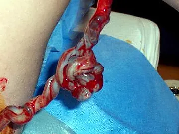 Cordón umbilical Cordón umbilical