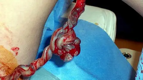 Cordón umbilical Cordón umbilical