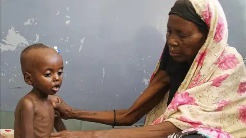 Una mujer somalí cuidad de su hijo de un año de edad en una clínica de Mogadiscio Una mujer somalí cuidad de su hijo de un año de edad en una clínica de Mogadiscio