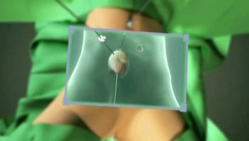 El Hospital Clinic practica con éxito una cirugía pionera para extraer el riñón por la vagina